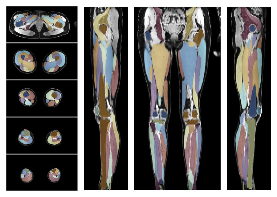 Overlay of automated muscle segmentation labels on dixon water image.